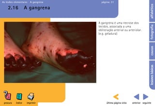 As lesões elementares   A gangrena     página: 31




                                                                                 alfabético
    2.16            A gangrena

                                     A gangrena é uma necrose dos




                                                                                 fotografia
                                     tecidos, associada a uma
                                     obliteração arterial ou arteriolar.
                                     (e.g. geladura)




                                                                                 causas
                                                                                 lesiones básicas
 procura   índice    imprimir              última página vista   anterior seguinte
 