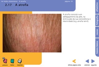 As lesões elementares   A atrofia     página: 32




                                                                                alfabético
    2.17            A atroﬁa

                                    A atrofia consiste num




                                                                                fotografia
                                    adelgaçamento da pele, na
                                    diminuição da sua consistência e
                                    elasticidade (e.g. atrofia senil).




                                                                                causas
                                                                                lesiones básicas
 procura   índice    imprimir             última página vista   anterior seguinte
 