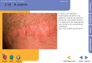 As lesões elementares   A cicatriz     página: 33




                                                                                 alfabético
    2.18            A cicatriz

                                     A cicatriz corresponde a




                                                                                 fotografia
                                     modificações da derme e da
                                     epiderme, sinal de um processo
                                     fibroso de intensidade variável.
                                     É o testemunho da reparação de
                                     uma ferida ou de uma perda de
                                     substância.




                                                                                 causas
                                     (e.g. cicatriz após queimadura)




                                                                                 lesiones básicas
 procura   índice    imprimir              última página vista   anterior seguinte
 