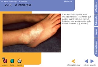 As lesões elementares   A esclerose     página: 34




                                                                                  alfabético
    2.19            A esclerose

                                      A esclerose corresponde a um




                                                                                  fotografia
                                      endurecimento do tegumento, que
                                      perde a sua flexibilidade normal.
                                      Está associada a uma condensação
                                      fibrosa na derme (e.g. morfeia).




                                                                                  causas
                                                                                  lesiones básicas
 procura   índice    imprimir               última página vista   anterior seguinte
 
