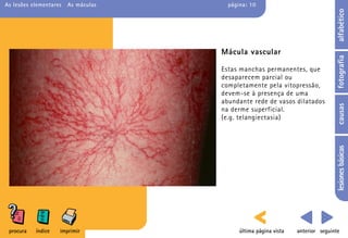 As lesões elementares   As máculas     página: 10




                                                                                 alfabético
                                     Mácula vascular




                                                                                 fotografia
                                     Estas manchas permanentes, que
                                     desaparecem parcial ou
                                     completamente pela vitopressão,
                                     devem-se à presença de uma
                                     abundante rede de vasos dilatados




                                                                                 causas
                                     na derme superficial.
                                     (e.g. telangiectasia)




                                                                                 lesiones básicas
 procura   índice   imprimir               última página vista   anterior seguinte
 