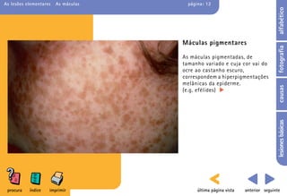 As lesões elementares   As máculas     página: 12




                                                                                 alfabético
                                     Máculas pigmentares




                                                                                 fotografia
                                     As máculas pigmentadas, de
                                     tamanho variado e cuja cor vai do
                                     ocre ao castanho escuro,
                                     correspondem a hiperpigmentações
                                     melânicas da epiderme.




                                                                                 causas
                                     (e.g. efélides)




                                                                                 lesiones básicas
 procura   índice   imprimir               última página vista   anterior seguinte
 