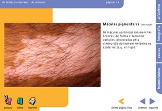 As lesões elementares   As máculas     página: 14




                                                                                 alfabético
                                     Máculas pigmentares           continuação




                                                                                 fotografia
                                     As máculas acrómicas são manchas
                                     brancas, de forma e tamanho
                                     variados, provocadas pela
                                     diminuição do teor em melanina na
                                     epiderme (e.g. vitiligo).




                                                                                 causas
                                                                                 lesiones básicas
 procura   índice   imprimir               última página vista   anterior seguinte
 