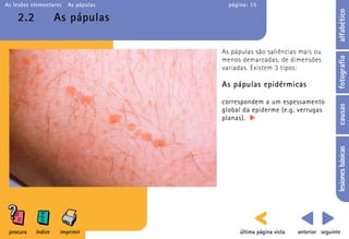 As lesões elementares   As pápulas     página: 15




                                                                                 alfabético
    2.2             As pápulas

                                     As pápulas são saliências mais ou




                                                                                 fotografia
                                     menos demarcadas, de dimensões
                                     variadas. Existem 3 tipos:

                                     As pápulas epidérmicas

                                     correspondem a um espessamento




                                                                                 causas
                                     global da epiderme (e.g. verrugas
                                     planas).




                                                                                 lesiones básicas
 procura   índice    imprimir              última página vista   anterior seguinte
 