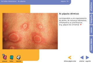 As lesões elementares   As pápulas     página: 16




                                                                                 alfabético
                                     As pápulas dérmicas




                                                                                 fotografia
                                     correspondem a um espessamento
                                     da derme, de natureza edematosa,
                                     inflamatória ou proliferativa.
                                     (e.g. pápula da urticária)




                                                                                 causas
                                                                                 lesiones básicas
 procura   índice   imprimir               última página vista   anterior seguinte
 