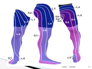 11/29/2023 19
Sciatica
 
