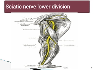 11/29/2023 7
Sciatic nerve low er division
Sciatica
 