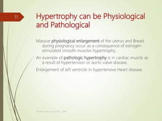 Hypertrophy can be Physiological
and Pathological
Massive physiological enlargement of the uterus and Breast
during pregnancy occur as a consequence of estrogen
stimulated smooth muscles hypertrophy .
An example of pathologic hypertrophy is in cardiac muscle as
a result of hypertension or aortic valve disease.
Enlargement of left ventricle in hypertensive Heart disease.
Tanveer Tara ,Lecture MLT , SUIR
11
 