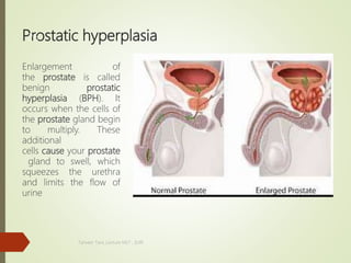 Prostatic hyperplasia
Enlargement of
the prostate is called
benign prostatic
hyperplasia (BPH). It
occurs when the cells of
the prostate gland begin
to multiply. These
additional
cells cause your prostate
gland to swell, which
squeezes the urethra
and limits the flow of
urine
Tanveer Tara ,Lecture MLT , SUIR
26
 