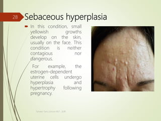 Sebaceous hyperplasia
 In this condition, small
yellowish growths
develop on the skin,
usually on the face. This
condition is neither
contagious nor
dangerous.
For example, the
estrogen-dependent
uterine cells undergo
hyperplasia and
hypertrophy following
pregnancy.
Tanveer Tara ,Lecture MLT , SUIR
28
 