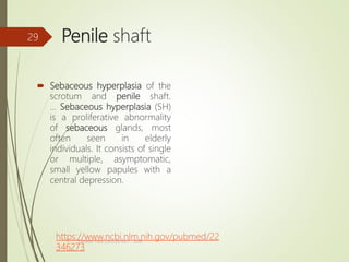 Penile shaft
 Sebaceous hyperplasia of the
scrotum and penile shaft.
... Sebaceous hyperplasia (SH)
is a proliferative abnormality
of sebaceous glands, most
often seen in elderly
individuals. It consists of single
or multiple, asymptomatic,
small yellow papules with a
central depression.
https://www.ncbi.nlm.nih.gov/pubmed/22
346273
Tanveer Tara ,Lecture MLT , SUIR
29
 