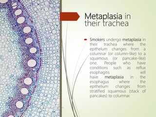 Metaplasia in
their trachea
 Smokers undergo metaplasia in
their trachea where the
epithelum changes from a
columnar (or column-like) to a
squamous (or pancake-like)
one. People who have
conditions such as reflux
esophagitis will
have metaplasia in the
esophagus where the
epithelium changes from
stratified squamous (stack of
pancakes) to columnar.
Tanveer Tara ,Lecture MLT , SUIR
34
 