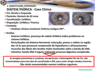 Dr. Clodoaldo Pacheco

                                                                                                    .
  1. CONSTITUIÇÃO, DISPOSIÇÃO.
  DIÁTESE PSÓRICA - Caso Clínico
 Íris: Direita e Esquerda
 Paciente: Homem de 62 anos
 Constituição: Linfática
 Disposição: Linfática / Psorica
 Contexto
       Análises clínicas revelaram linfoma maligno NH*.
 Análise
    - Sistema Linfático: presença de radiais linfático indica problemas no
      sistema linfático.
    - Perturbações do Sistema Hormonal: coloração, psoras e radiais na região
      das 12 hs que provocam compressão do hipotálamo e afrouxamentos
      muscular das fibras dos tecidos moles localizadas sobre a banda do SNA.
    - Intestino: banda SNA irregular indicando processo digestivo complicado.

    As terapias preventivas e curativas, em particular a Naturopatia Flor de Íris, são
recomendadas para este tipo de constituição e OPI, para evitar atingir estados tumorais.
                         São ainda recomendados exames médicos regulares.
                                                                            TERAPIA FLOR DE ÍRIS®
 