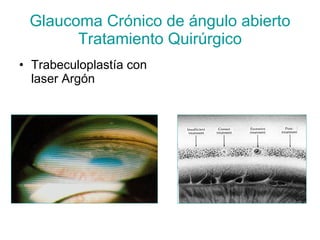 Glaucoma Crónico de ángulo abierto
       Tratamiento Quirúrgico
• Trabeculoplastía con
  laser Argón
 