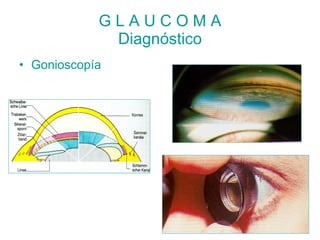 GLAUCOMA
             Diagnóstico
• Gonioscopía
 
