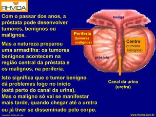 Com o passar dos anos, a                               bexiga
próstata pode desenvolver
tumores, benignos ou
malignos.                      Periferia
                               (tumores
                                malignos)                       Centro
Mas a natureza preparou                                         (tumores
uma armadilha: os tumores                                        benignos)
benignos acontecem na                       próstata
região central da próstata e
os malignos, na periferia.
Isto significa que o tumor benigno
                                                   Canal da urina
dá problemas logo no início
                                                      (uretra)
(está perto do canal da urina).
Mas o maligno só vai se manifestar
mais tarde, quando chegar até a uretra
ou já tiver se disseminado pelo corpo.
Copyright © RHVIDA S/C Ltda.                                      www.rhvida.com.br
 