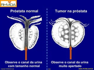 Próstata normal            Tumor na próstata




        Observe o canal da urina             Observe o canal da urina
         com tamanho normal                      muito apertado
Copyright © RHVIDA S/C Ltda.          INCA                    www.rhvida.com.br
 