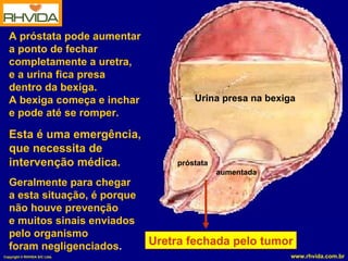 A próstata pode aumentar
   a ponto de fechar
   completamente a uretra,
   e a urina fica presa
   dentro da bexiga.
   A bexiga começa e inchar            Urina presa na bexiga
   e pode até se romper.

   Esta é uma emergência,
   que necessita de
   intervenção médica.             próstata
                                              aumentada
   Geralmente para chegar
   a esta situação, é porque
   não houve prevenção
   e muitos sinais enviados
   pelo organismo
   foram negligenciados.       Uretra fechada pelo tumor
Copyright © RHVIDA S/C Ltda.                               www.rhvida.com.br
 