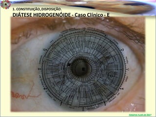 Dr. Clodoaldo Pacheco

  1. CONSTITUIÇÃO, DISPOSIÇÃO.                                      .

  DIÁTESE HIDROGENÓIDE - Caso Clínico - E




                                            TERAPIA FLOR DE ÍRIS®
 