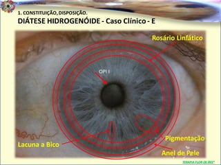 Dr. Clodoaldo Pacheco

  1. CONSTITUIÇÃO, DISPOSIÇÃO.                                             .

  DIÁTESE HIDROGENÓIDE - Caso Clínico - E

                                         Rosário Linfático



                                 OPI I




                                             Pigmentação
  Lacuna a Bico
                                            Anel de Pele
                                                   TERAPIA FLOR DE ÍRIS®
 