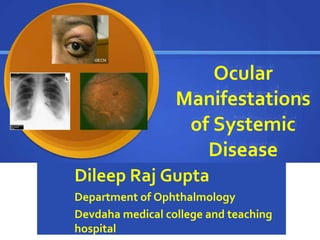 ©ECN
Ocular
Manifestations
of Systemic
Disease
Dileep Raj Gupta
Department of Ophthalmology
Devdaha medical college and teaching
hospital
 