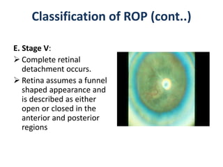 seminar on ROP - retinopathy of prematurity | PPTX