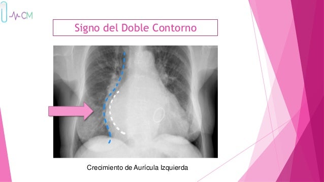 004-pleura-mediastino-y-cardiovascular-era-2