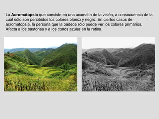 La  Acromatopsia  que consiste en una anomalía de la visión, a consecuencia de la cual sólo son percibidos los colores blanco y negro. En ciertos casos de acromatopsia, la persona que la padece sólo puede ver los colores primarios. Afecta a los bastones y a los conos azules en la retina. 