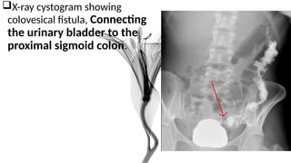 Traditional Cystogram 0061 FISTULOGRAPHY - Copy.pptxmmmmmmmmmmmmmmmmmmmmmmm | PPTX