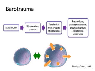 Barotrauma
Slutsky, Chest, 1999
 