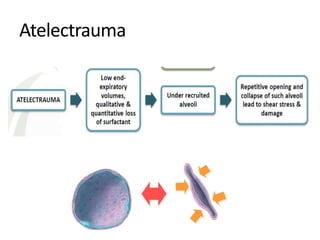 Atelectrauma
 