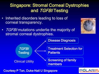 Singapore: Stromal Corneal Dystrophies and TGFBI Testing 
•Inherited disorders leading to loss of corneal transparency. 
•TGFBI mutations underlie the majority of stromal corneal dystrophies. 
Screening of family members 
Disease Diagnosis 
Treatment Selection for Patients 
TGFBI Testing 
Clinical Utility 
Courtesy P Tan, Duke-Natl U Singapore  