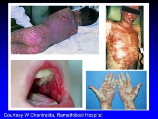 Courtesy W Chantratita, Ramathibodi Hospital  