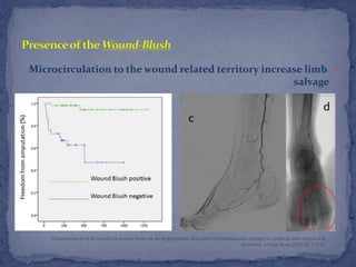 Michael Knizhnik — Endovascular treatment for patients with critical ...