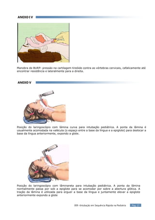 009 intubacao em_sequencia_rapida_na_pediatria_17092014 | PDF