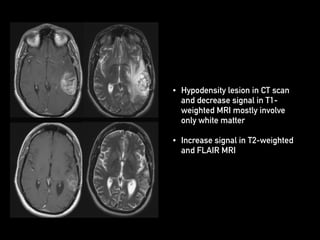 • Hypodensity lesion in CT scan
and decrease signal in T1-
weighted MRI mostly involve
only white matter
• Increase signal in T2-weighted
and FLAIR MRI
 