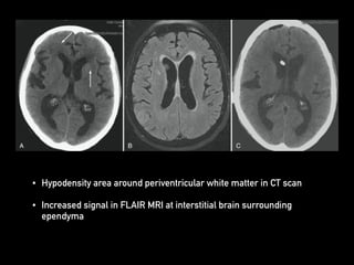 • Hypodensity area around periventricular white matter in CT scan
• Increased signal in FLAIR MRI at interstitial brain surrounding
ependyma
 