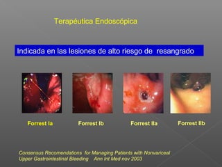 Terapéutica Endoscópica
Indicada en las lesiones de alto riesgo de resangrado
Forrest Ia Forrest Ib Forrest IIa Forrest IIb
Consensus Recomendations for Managing Patients with Nonvariceal
Upper Gastrointestinal Bleeding Ann Int Med nov 2003
 
