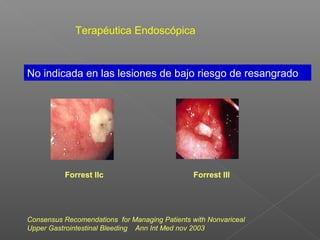 Consensus Recomendations for Managing Patients with Nonvariceal
Upper Gastrointestinal Bleeding Ann Int Med nov 2003
Terapéutica Endoscópica
No indicada en las lesiones de bajo riesgo de resangrado
Forrest IIc Forrest III
 