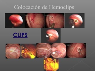 Colocación de Hemoclips
 