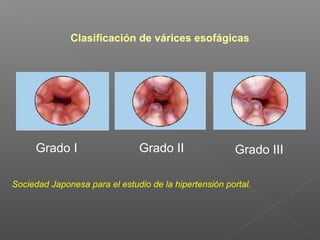 Clasificación de várices esofágicas
Grado I Grado II Grado III
Sociedad Japonesa para el estudio de la hipertensión portal.
 