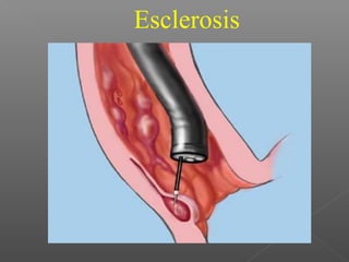 Esclerosis
 
