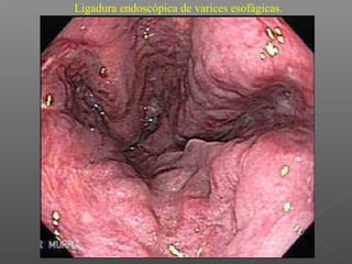 Ligadura endoscópica de varices esofágicas.
 
