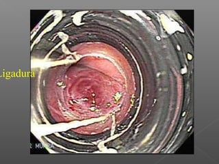 Ligadura
 