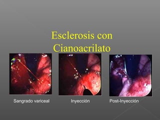 Sangrado variceal Inyección Post-Inyección
Esclerosis con
Cianoacrilato
 