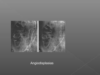 Angiodisplasias
 