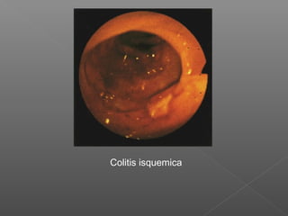Colitis isquemica
 