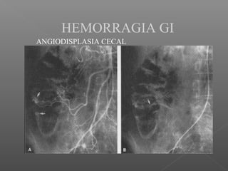 HEMORRAGIA GI
ANGIODISPLASIA CECAL
 