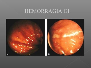 HEMORRAGIA GI
 