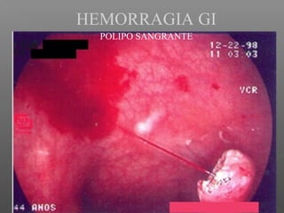 HEMORRAGIA GI
POLIPO SANGRANTE
 